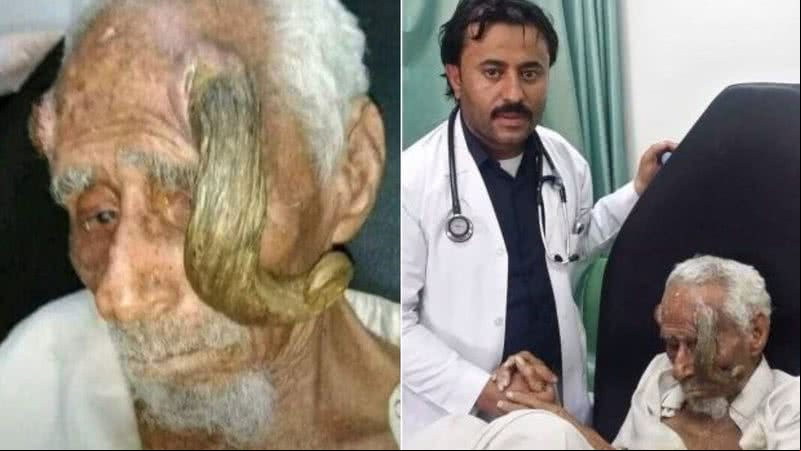 Ali Anter, o homem que afirmou ter 140 anos e morreu depois de realizar cirurgia para retirar protuberância semelhante a um chifre - Reprodução/Vídeo